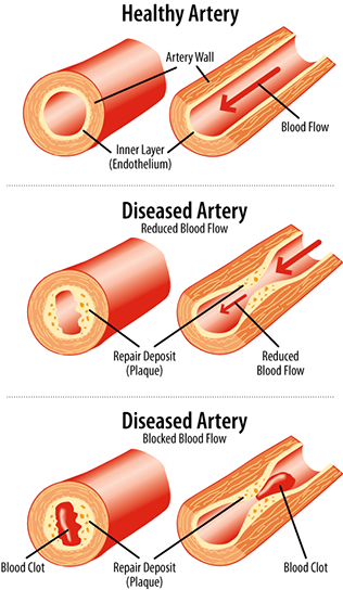 Three diagrams showing a healthy artery and a progressively blocked artery due to improper nutrition causing repair deposits.